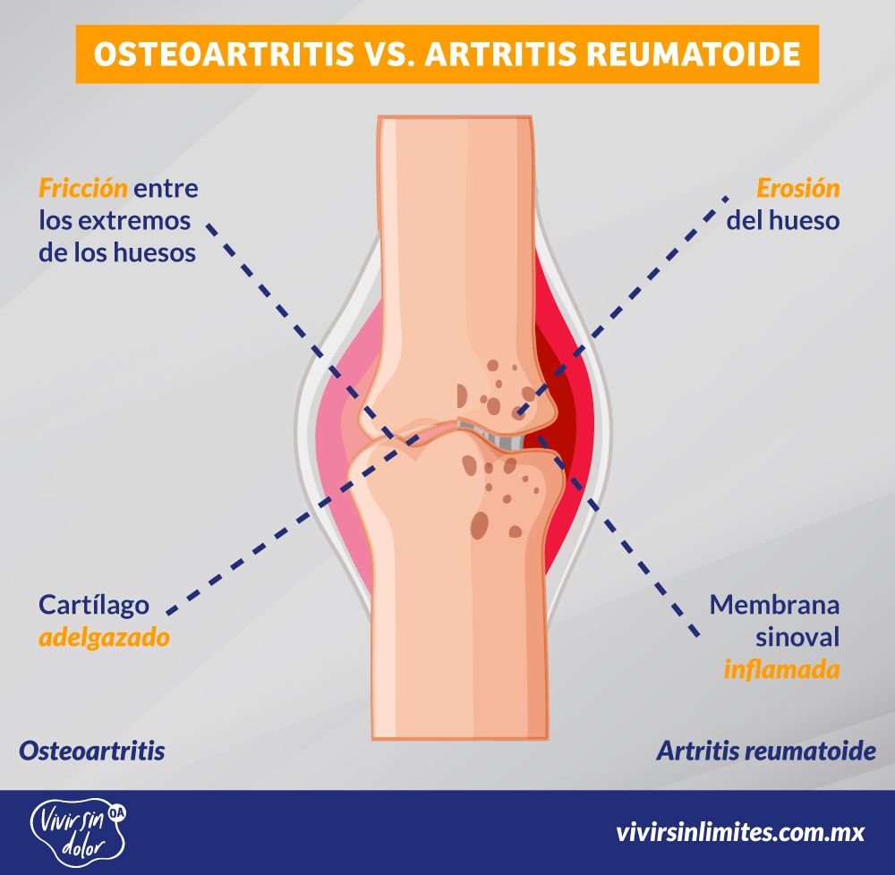 Infografia-Osteoartritis-Artritis-OA